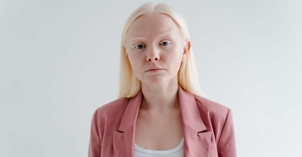 Significado de soñar con albino - 35 tipos y sus interpretaciones