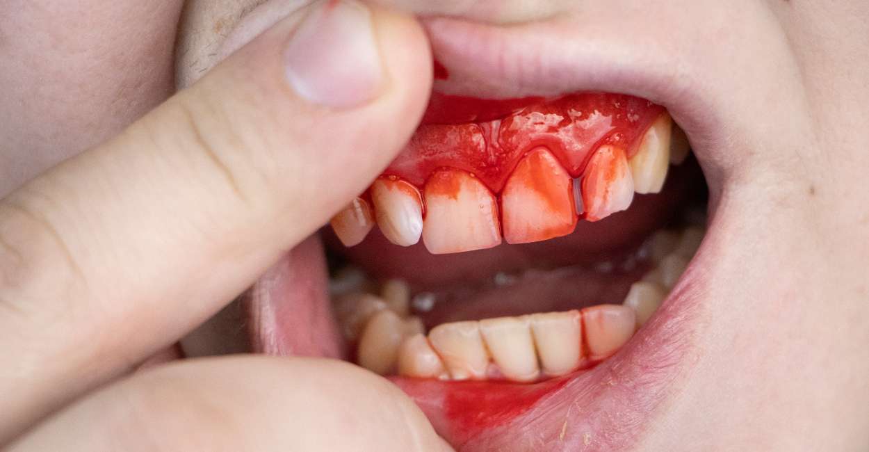 Soñar con sangrado de dientes: 20 tipos y sus interpretaciones